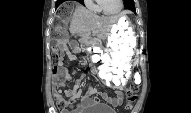 Из кишечника мужчины вытащили 2 килограмма проглоченных камней